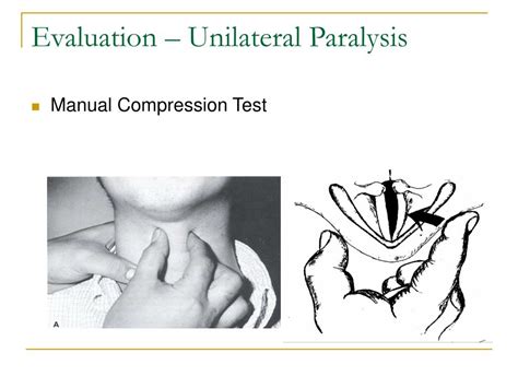 manual compression test larynx|Effects of lateral manual compression upon glottic incompetence .